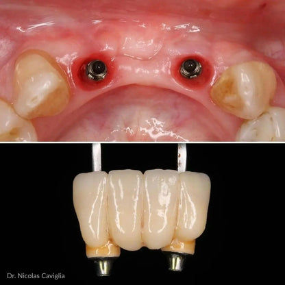 CEREC® Bridge Blocks Lithium Disilicate (e.max) B40