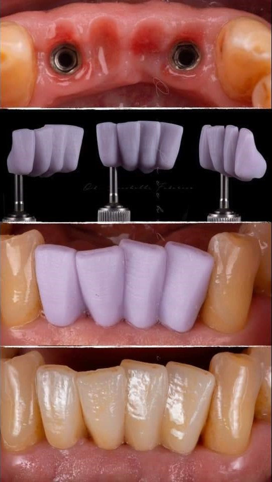 CEREC® Blocks - Lithium Disilicate #14 - Same as E.max. 5 Blocks